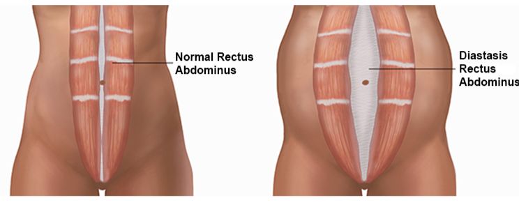 Diastasis Recti: The Five Things You Need To Know About Abdominal